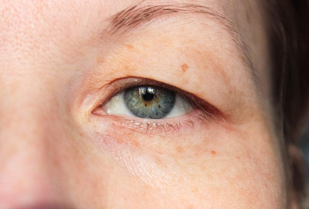 علت افتادگی پلک چشم چیست و چطور درمان می شود؟