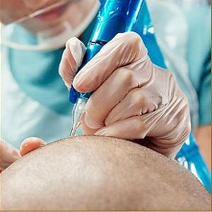 مزوتراپی موثر در درمان ریزش موی سر