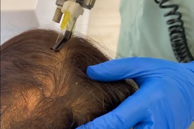 مزوتراپی برای درمان ریزش مو در رشت