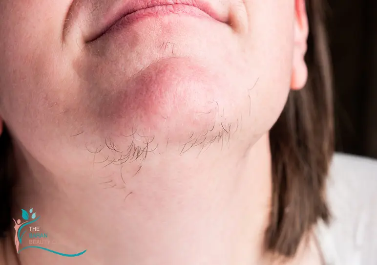 چه چیزی باعث رشد موهای زائد می‌شود؟