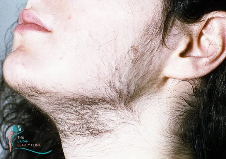 چه غذاهایی باعث افزایش موهای زائد می‌شود؟