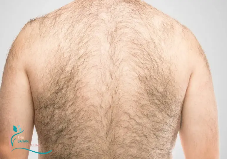 چگونه مردان رشد موهای زائد را متوقف کنند؟