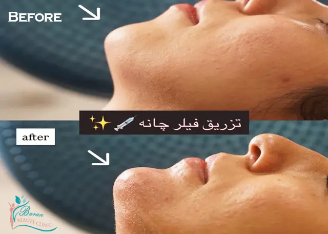 تزریق فیلر و ژل چانه در رشت