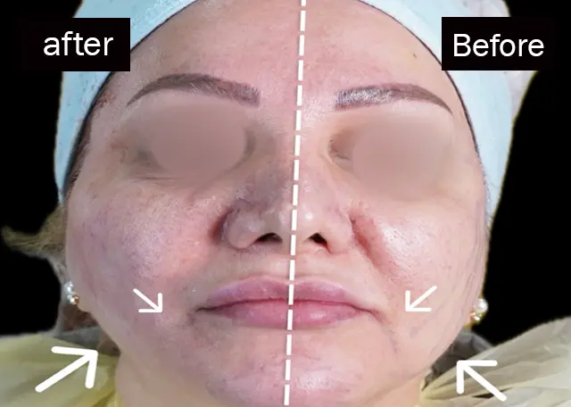 لیفت نخ در رشت 3 عکس قبل و بعد لیفت نخ در رشت