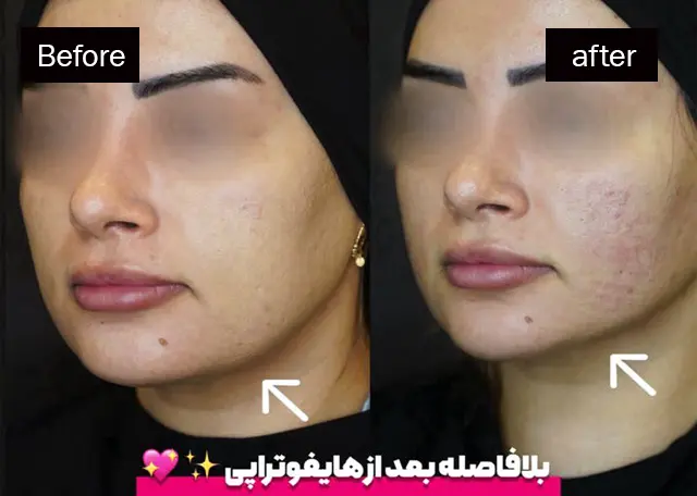 هایفوتراپی در رشت 14 عکس قبل و بعد هایفوتراپی صورت در رشت