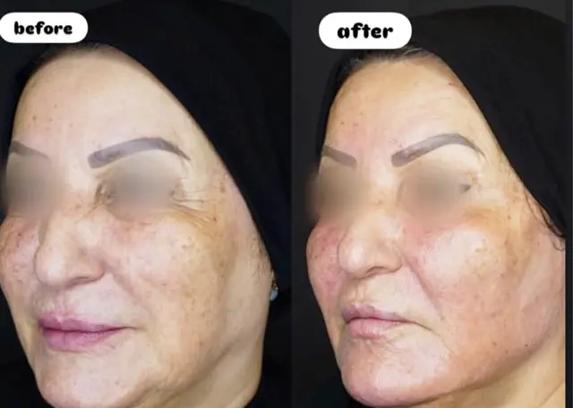 تزریق فیلر و ژل در رشت 8 تزریق فیلر و ژل صورت