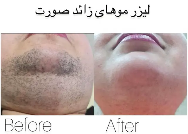 لیزر موی زائد صورت در رشت گلسار
