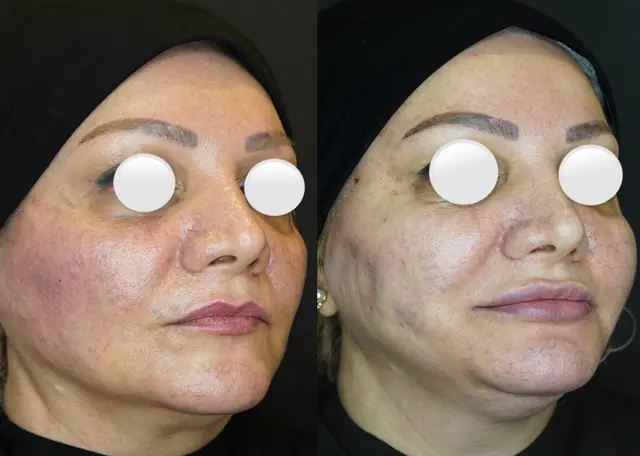 لیفت نخ در رشت 14 عکسهای لیفت صورت با نخ در رشت