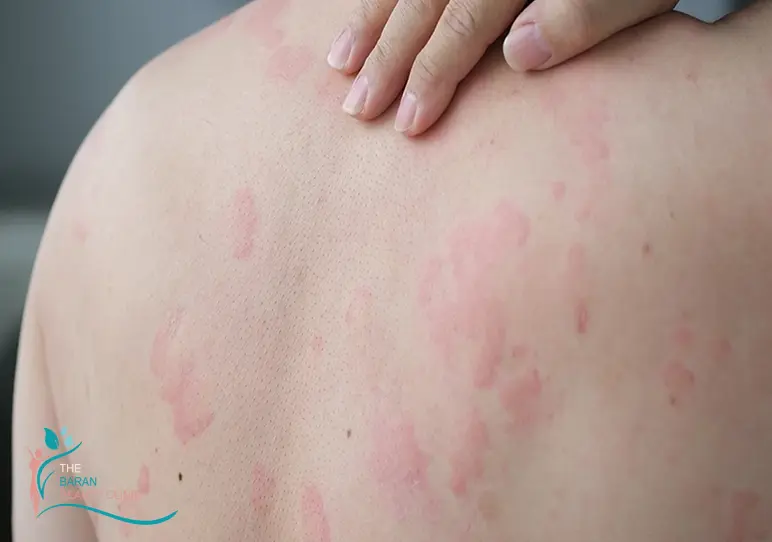 عوارض وحشتناک لیزر موهای زائد 1 لیزر موهای زائد برای چه کسانی ضرر دارد؟