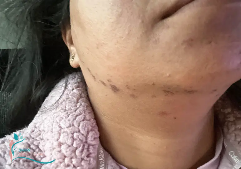 عوارض وحشتناک لیزر موهای زائد 3 نظر پزشکان در مورد لیزر موهای زائد چگونه است؟