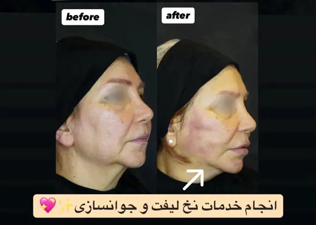 لیفت نخ در رشت 2 عکس قبل و بعد خدمات لیفت نخ در رشت کلینیک باران
