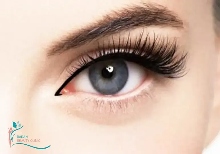 بوتاکس چشم گربه ای رشت 2 مزایای بوتاکس چشم گربه ای
