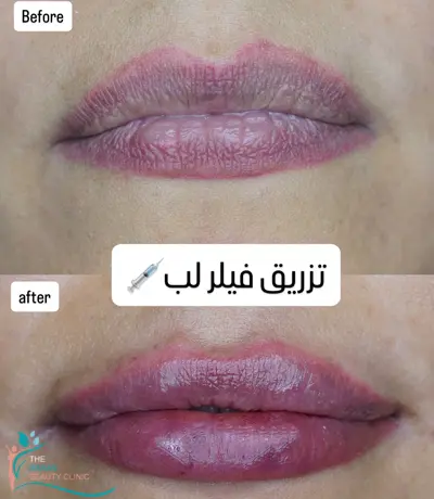 تزریق فیلر و ژل در رشت 19 Filler injections in Rasht