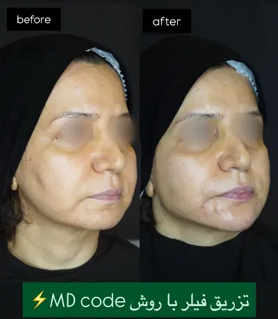 تزریق فیلر و ژل در رشت 20 Filler injections in Rasht1