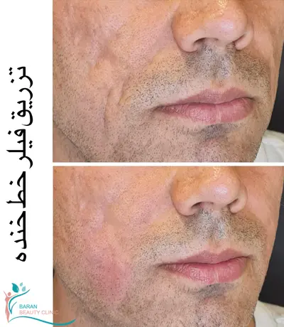 تزریق فیلر و ژل در رشت 21 Filler injections in Rasht2