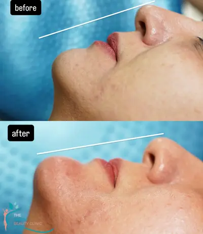 تزریق فیلر و ژل در رشت 22 Filler injections in Rasht3