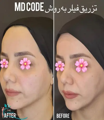 تزریق فیلر و ژل در رشت 24 Filler injections in Rasht5