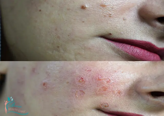 خال برداری در رشت 3 قیمت خال برداری در رشت با لیزر و دستگاه Rf surgery