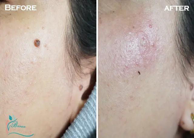 خال برداری در رشت 15 از بین بردن خال و خالبرداری در رشت