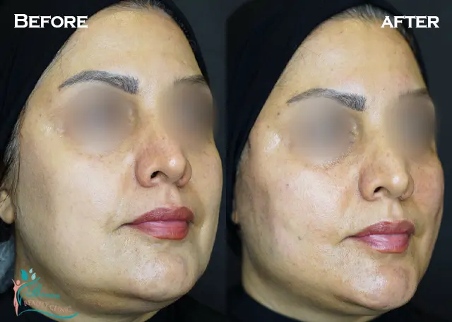 لیفت نخ در رشت 14 بهترین مرکز لیفت نخ صورت در رشت