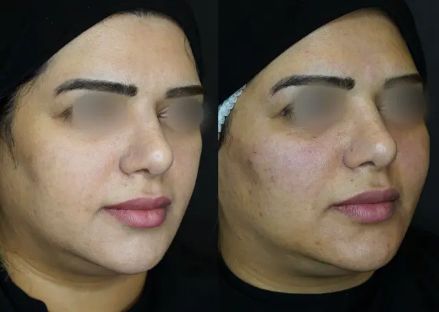 هزینه تزریق ژل لب در رشت چقدر است؟ باران