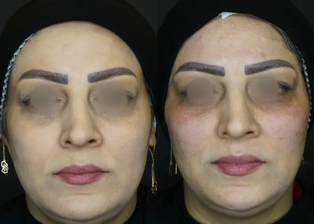 بهترین دکتر هایفوتراپی در رشت. کلینیک باران رشت