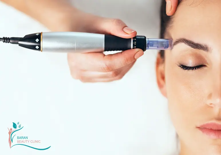 میکرونیدلینگ در رشت