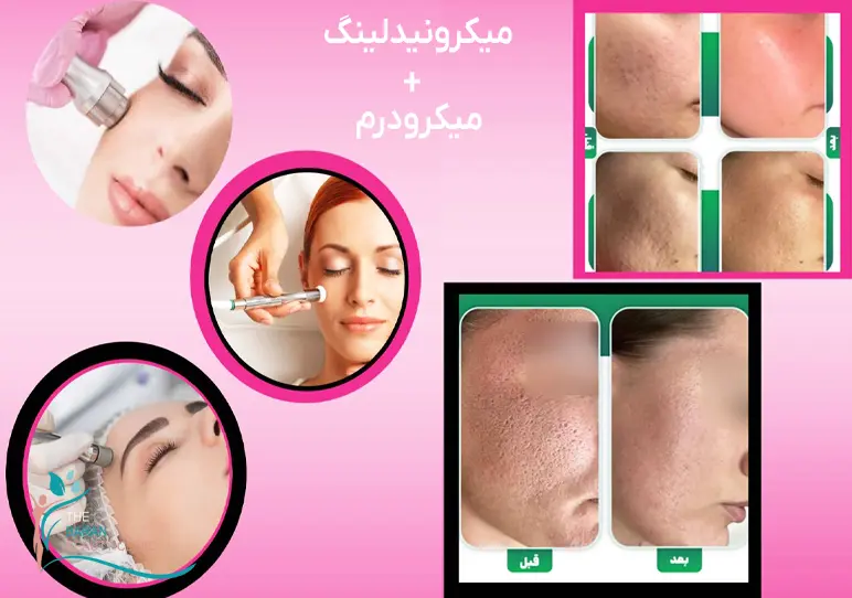 قیمت میکرونیدلینگ در رشت 1405