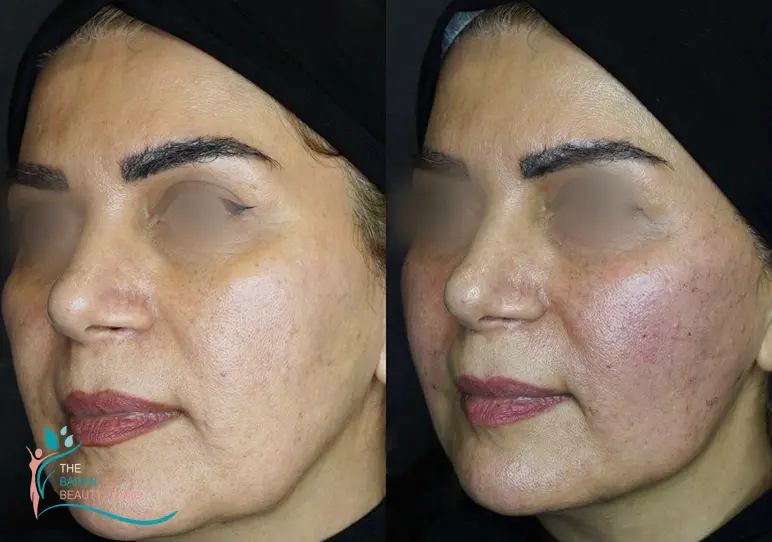 بهترین دکتر فیشیال صورت در رشت