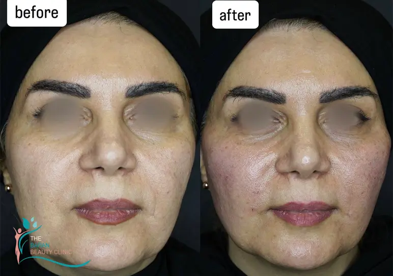 قیمت پاکسازی و فیشیال پوست در رشت